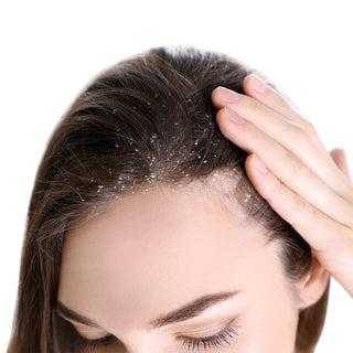 
  
    Dandruff
  
